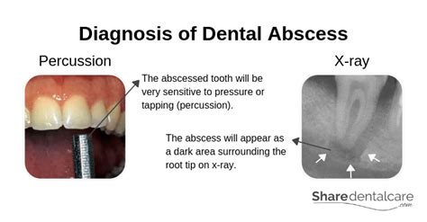 Dental Abscess Symptoms Causes And Treatment Share Dental Care
