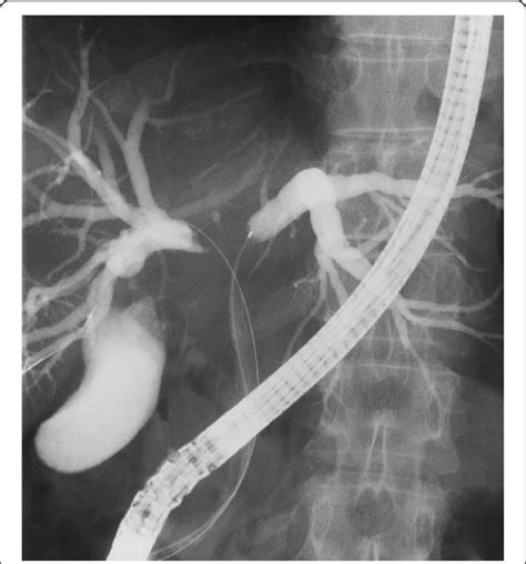 Cholangiographic Finding Cholangiography After Ercp And Enbd Showed