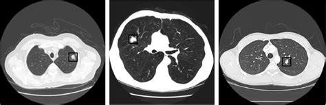 Categories Of Lung Nodules In A Ct Scan Benign Primary Malignant And
