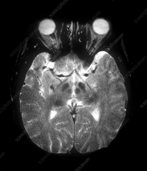 Parkinsons Disease Brain Mri Scan Stock Image C0041463 Science
