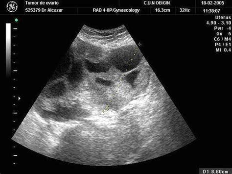 Ovarian cancer is the fifth most common cancer among women. Ovarian Tumors (Serous/Mucinous/Endometrioid/Clear Cell ...