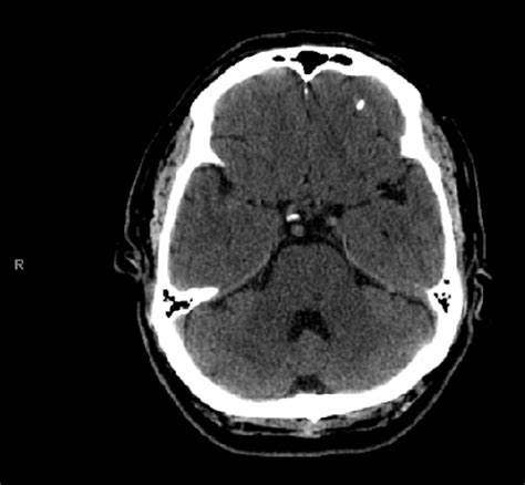 Ct Head Without Contrast Done 48 Hours From Admission Showing A Small