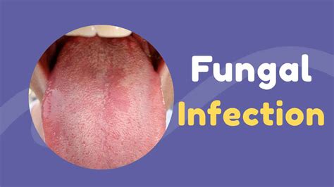 Fungal Infections 7 Types Causes Risk Factors Symptoms And Home
