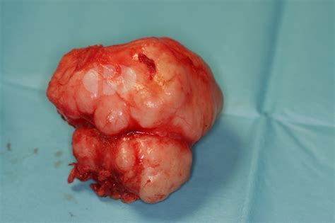 50% occur in tail, 25% in superficial lobe, 25%. Adenoma pleomorfo » Clínica Dental Borrás