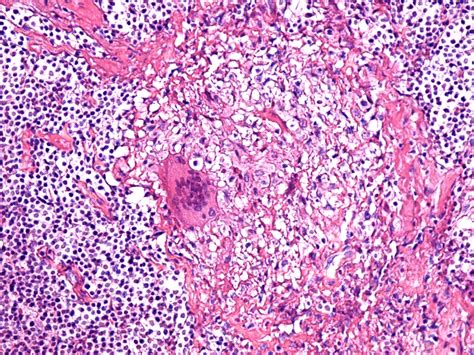 Detail Of A Multinucleate Langhans Cell At The Periphery Of A Tb