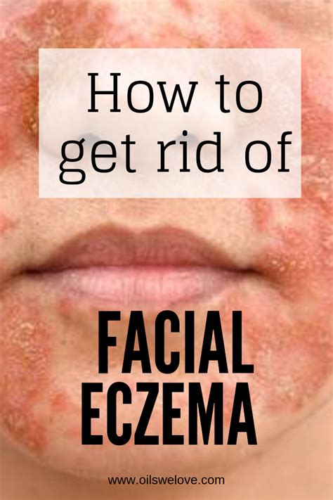 Eczema Skin Rashes Treatment