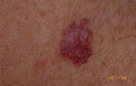 Tiny Pinpoint Red Dots On Skin Pictures Emailholden