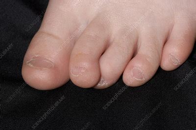 Overlapping Toes Stock Image M350 0336 Science Photo Library
