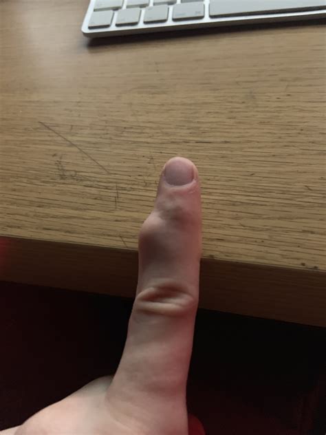 Lump On Finger How Do I Get Rid Of It Other Conditions And General