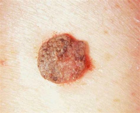 Seborrheic Keratosis Pictures Symptoms Treatment Removal And Causes Images And Photos Finder