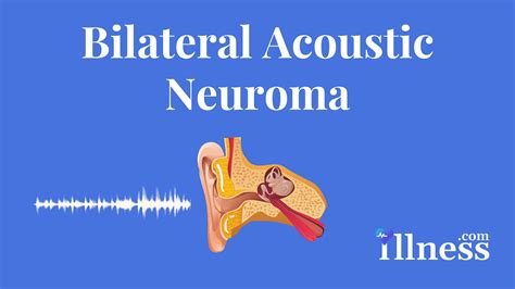 Bilateral Acoustic Neuroma Overview Causes Symptoms Treatment
