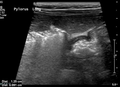 Pyloric Stenosis Uams Department Of Radiology