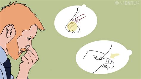 How To Stop Nose Bleeding