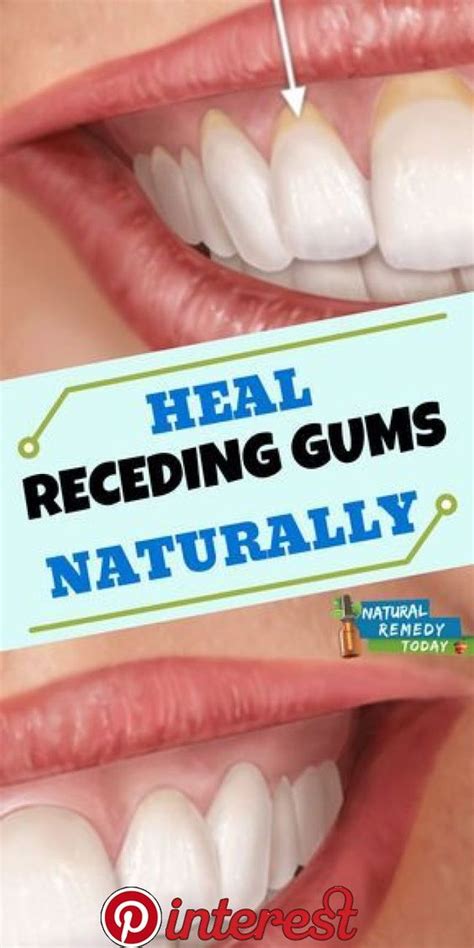 Healthy 4 10 Easy Ways To Heal Receding Gums Naturally