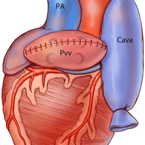 Perfusion Of Blood Through The Heterotopic Cardiac Graft The Graft Is