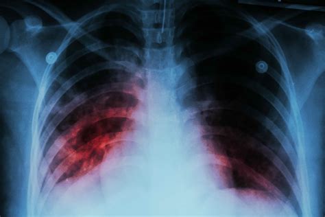 Interstitial Lung Disease Stock Photos Interstitial Lung Disease My
