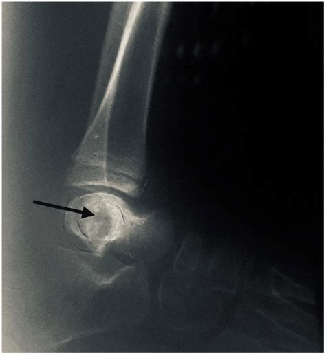 X Ray Of Ankle Joint Showing Lytic Lesion In The Talus Download
