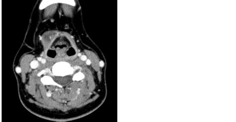 Preoperative Diagnosis Of Thyroglossal Duct Cancer A Case Report And