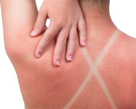 Sunburns — How Bad Are They Really Seacoast Dermatology Dermatology