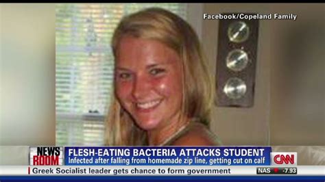 Flesh Eating Bacteria Infects Woman Cnn