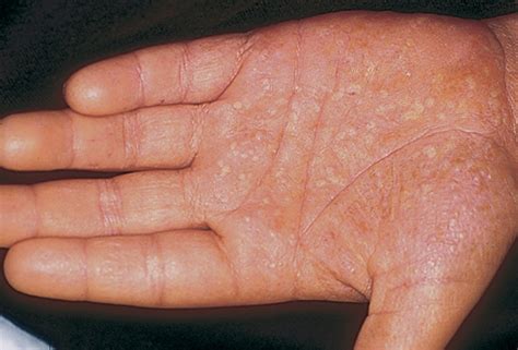 What Causes Blisters On Palms Of Hands