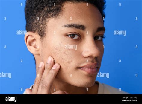 African American Teenage Boy With Acne Problem On Color Background
