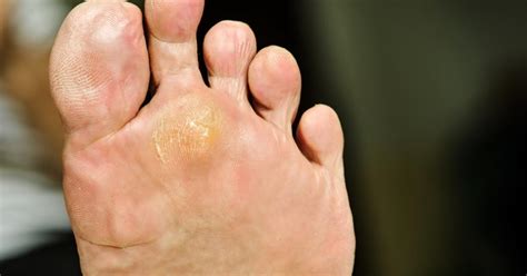 How to treat and prevent plantar warts