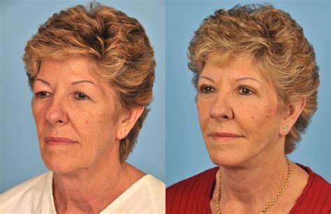 Best Facelift And Neck Lift Plastic Surgeon In Toronto Ford Plastic
