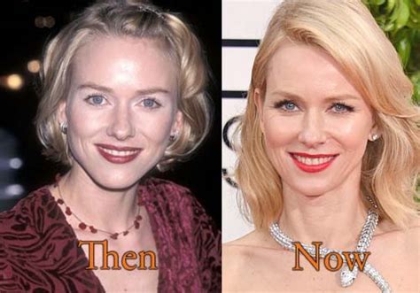 Naomi Watts Plastic Surgery Topcelebritysurgery