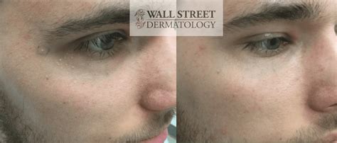Milia Extraction Nyc Wall Street Dermatology