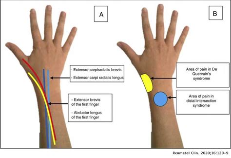 De Quervain Tenosynovitis Compartment Indian Physiotherapists