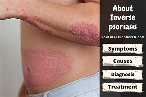 About Inverse Psoriasis With Causes And Treatment Decisions