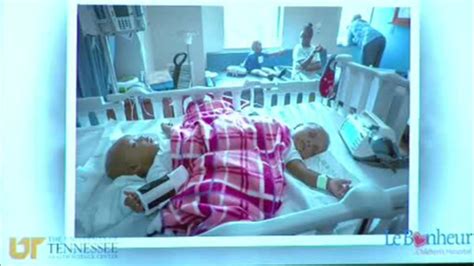 Conjoined Twins From Nigeria Successfully Separated Abc7 Chicago