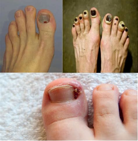 What Is Toenail Blister Causes And Treatment Sitename