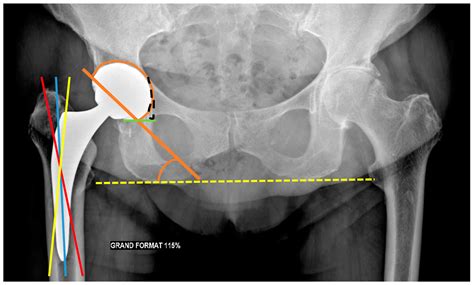 Jcm Free Full Text Imaging In Hip Arthroplasty Management Part 2