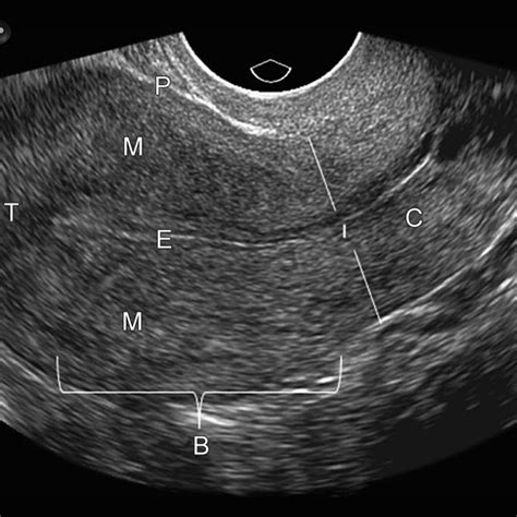 Transvaginal Ultrasound Of The Uterus Note The Uterine Fundus F
