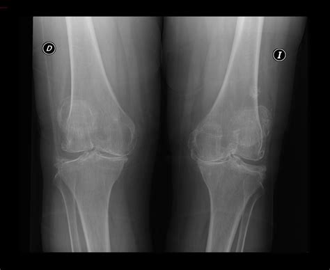 Artrosis Rodilla Cirugía ortopédica