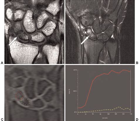 Figure From Imaging And Treatment Of Scaphoid Fractures And Their Complications Semantic