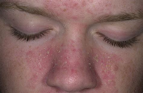 The Seborrheic Dermatitis Blog Solutions For Red Itchy Flaky