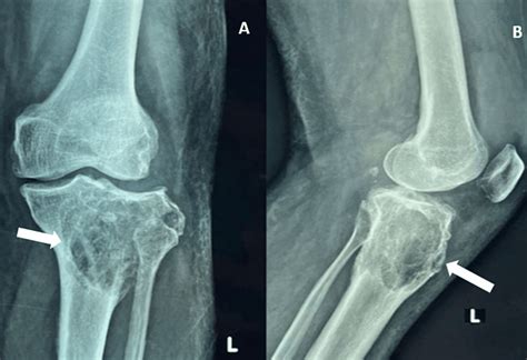 Cureus The Rare Occurrence Of Giant Cell Tumor Of The Proximal Tibia