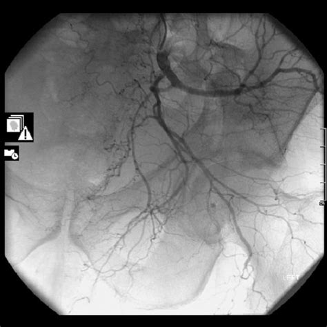 Ct Angiogram Of Internal Iliac Artery Download Scientific Diagram