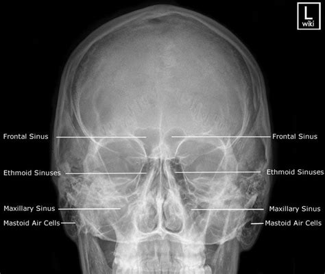Sinuses Radiographic Anatomy Wikiradiography Radiology Facial Bones Medical Radiography