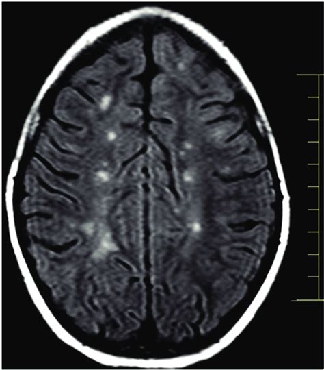 Brain Mri Showing Multiple Juxtacortical Lesions Download Scientific
