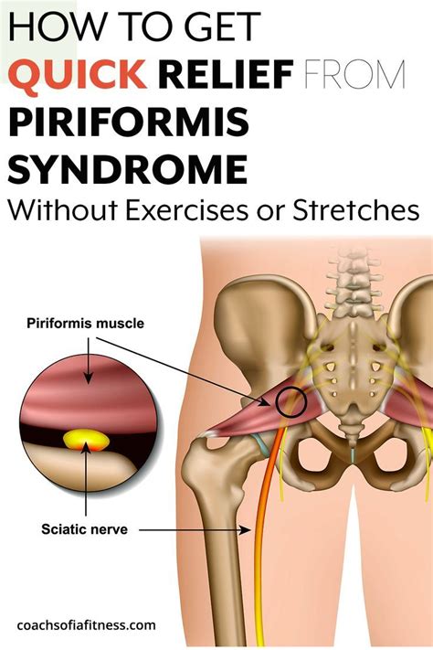 How To Get Relief From Piriformis Syndrome Quickly Amazing Tips To Help You Get Relief
