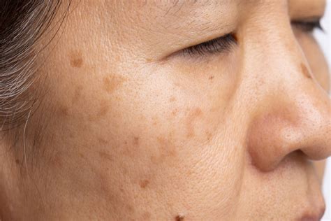 Melasma And The Various Treatments That May Help Treat It