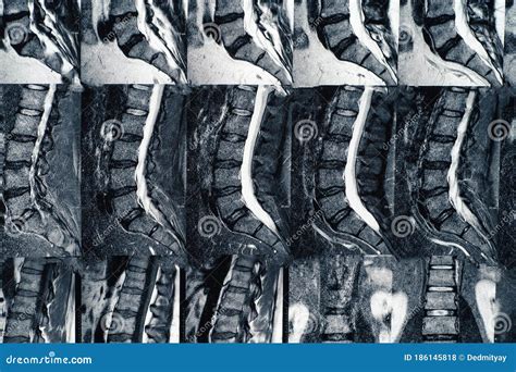Macro Photo Of Mri Of Lumbar Spine With Osteochondrosis Age Related