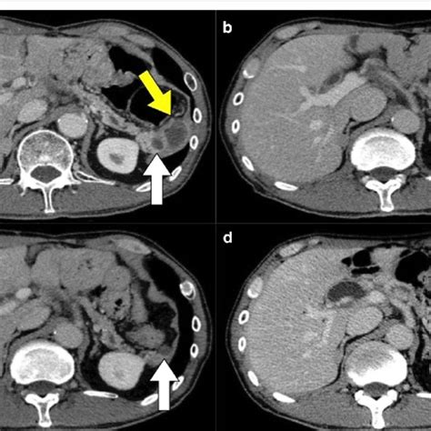 Contrast Enhanced Computed Tomography Ct Findings Ct Showed A