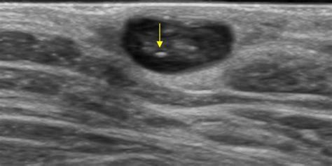 Breast And Axilla 56 Axilla Case 561 Axilla Ultrasound Cases