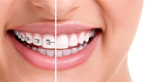 Orthodontic Braces Treatment Cosmetic Dental Implant Centre Cdic Wakad