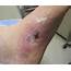 Wound Healing And Treating Wounds  Journal Of The American Academy
